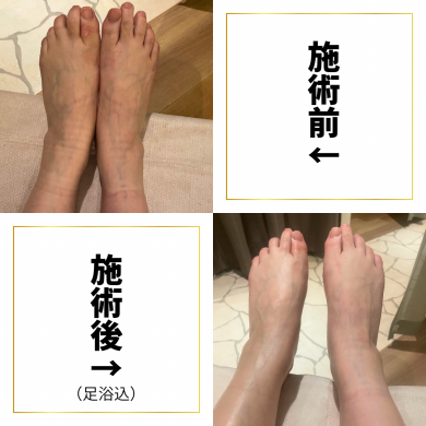 むくみで靴がキツくなりやすい方に👣